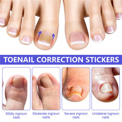 Ingrown Toenail Corrector Correction Patch Strips 100PCS