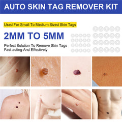 Wart or Skin Tag Remover Kit