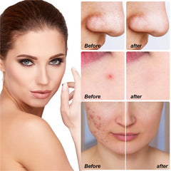 10Pcs/box Hydrocolloid Acne Patch Forehead And Cheeks Pimple Patches