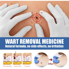 Wart Removal Body Warts Treatment Cream Foot Care Cream Skin Tag Remover