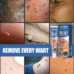 Wart Removal Body Warts Treatment Cream Foot Care Cream Skin Tag Remover