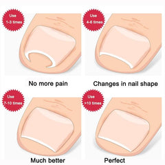 Ingrown Toenail Toe Fixer Recover Correction Device Pedicure Foot Nail Care Tool