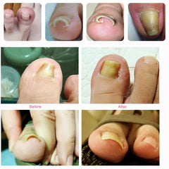 Ingrown Toenail Toe Fixer Recover Correction Device Pedicure Foot Nail Care Tool