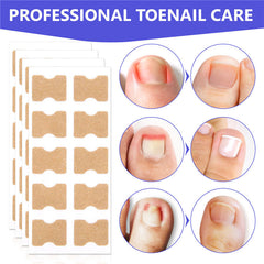 Ingrown Toenail Corrector Correction Patch Strips 100PCS