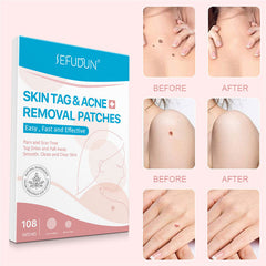 Natural Painless Auto Skin Tag Removal Kit Skin Tag Bands Remover Patches