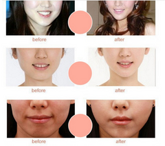 5pcs/Box Double V Line Shaped Slimming Contour Face Mask